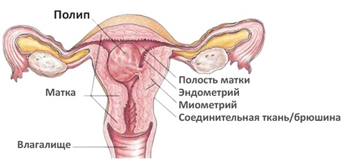 Полип При Беременности Фото